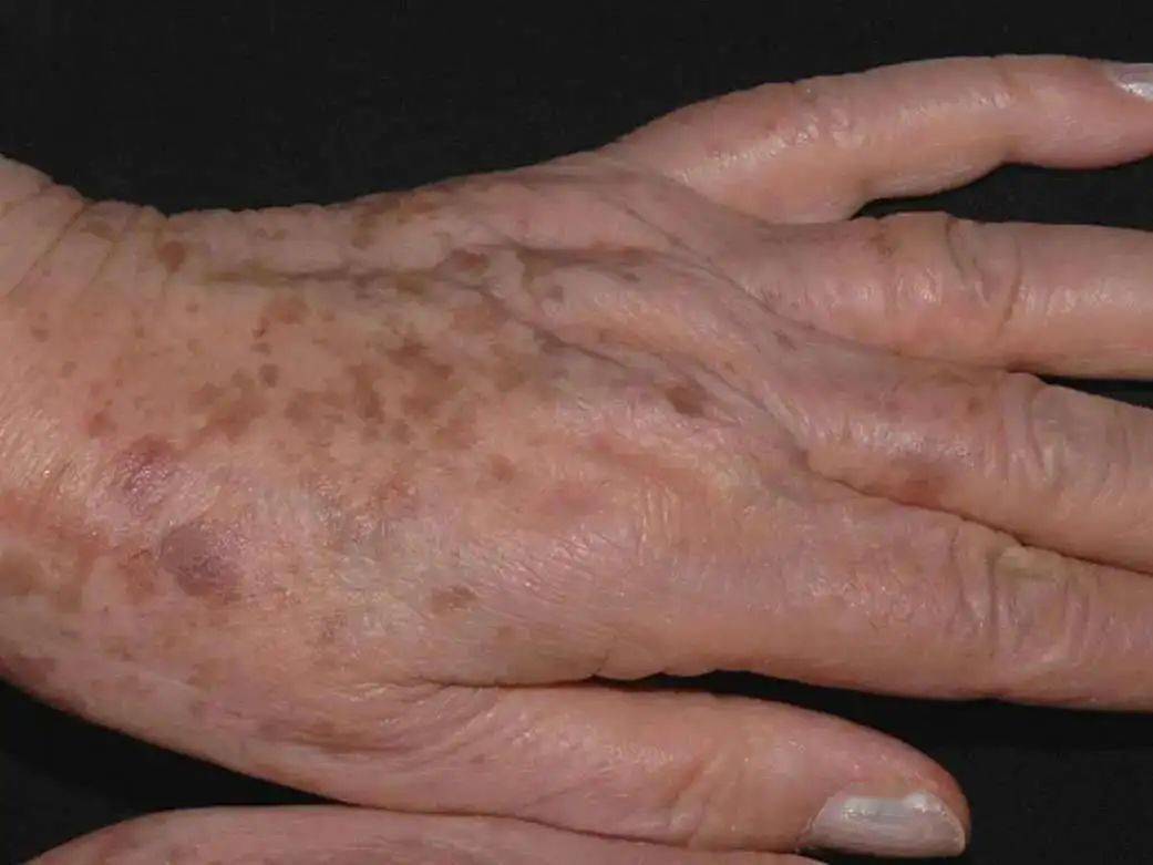 日光性雀斑样痣局限在日晒部位,例如面部,手背和前臂.年龄越大越常见.