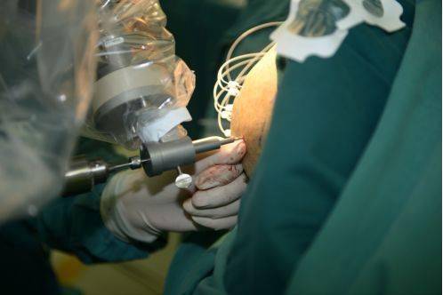 癫痫科普丨脑电图准不准关键看这几点