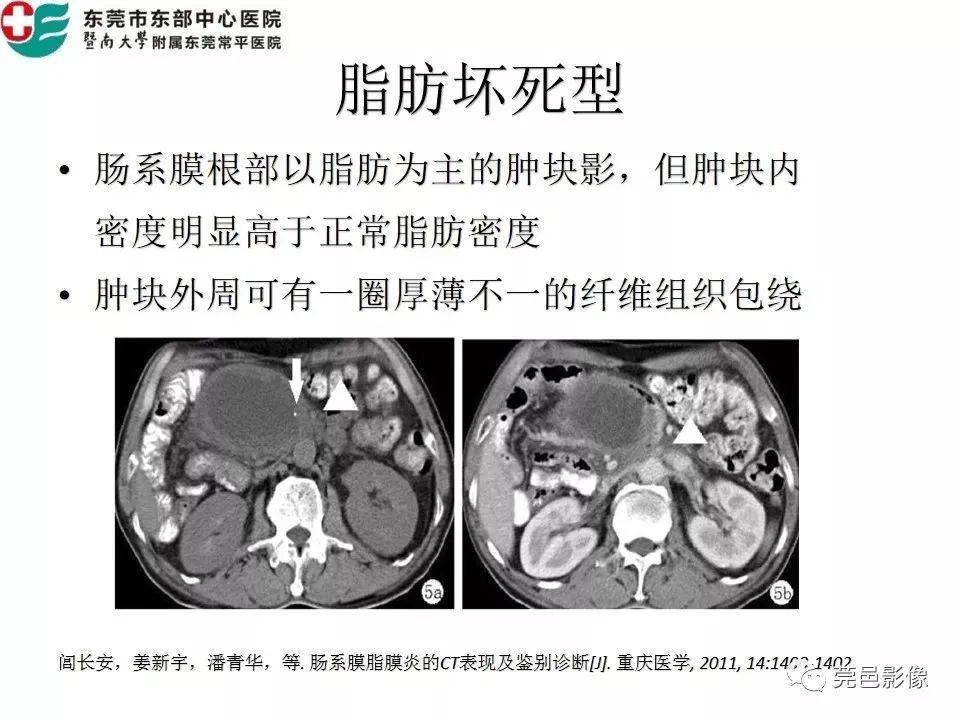 脂膜炎CT图片