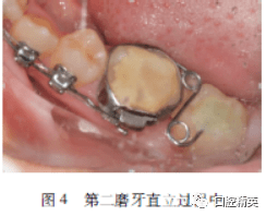 41mm鎳鈦圓絲,順序更換主弓絲,排齊牙列.