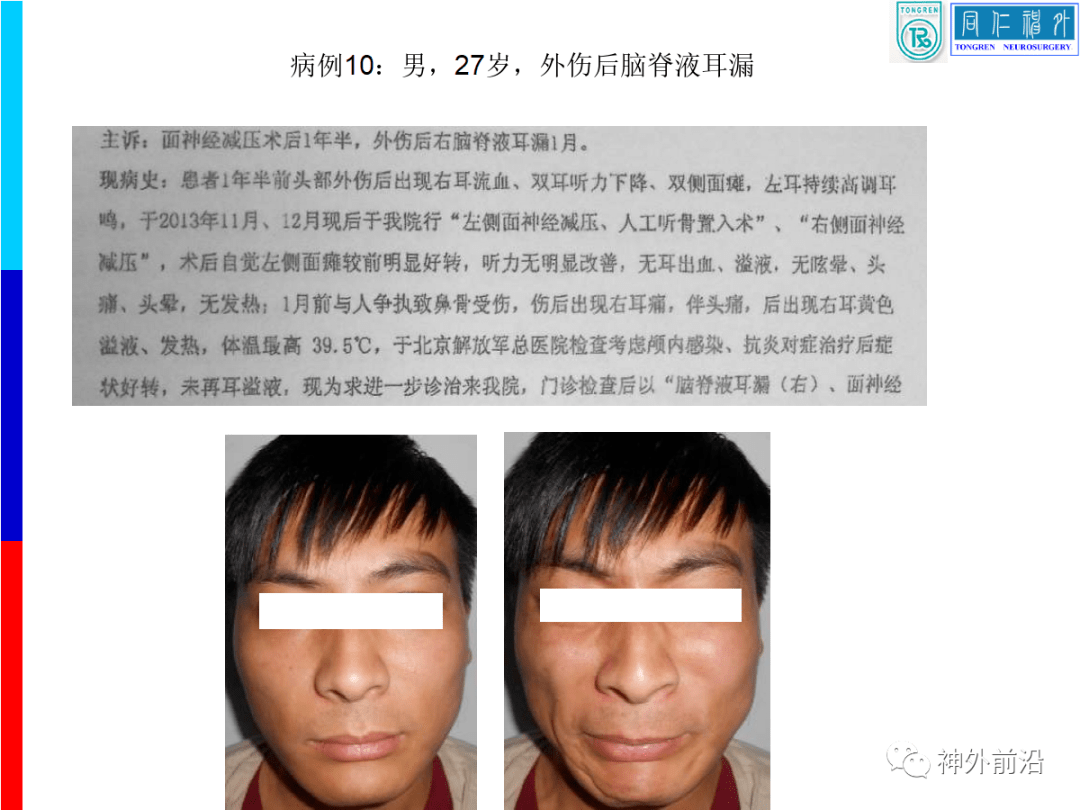 手术案例附:视频讲解康军:很多脑脊液耳漏的患者,在