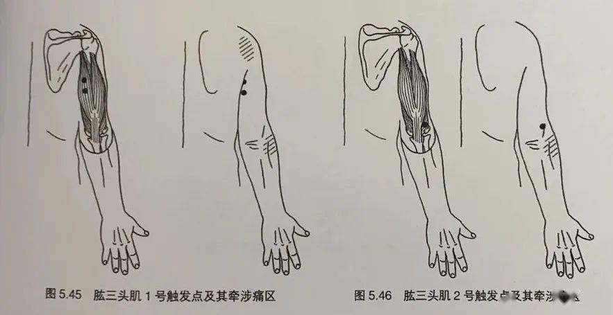 3号触发点位于肱三头肌外侧头,引起的疼痛在它所在的上臂后区.