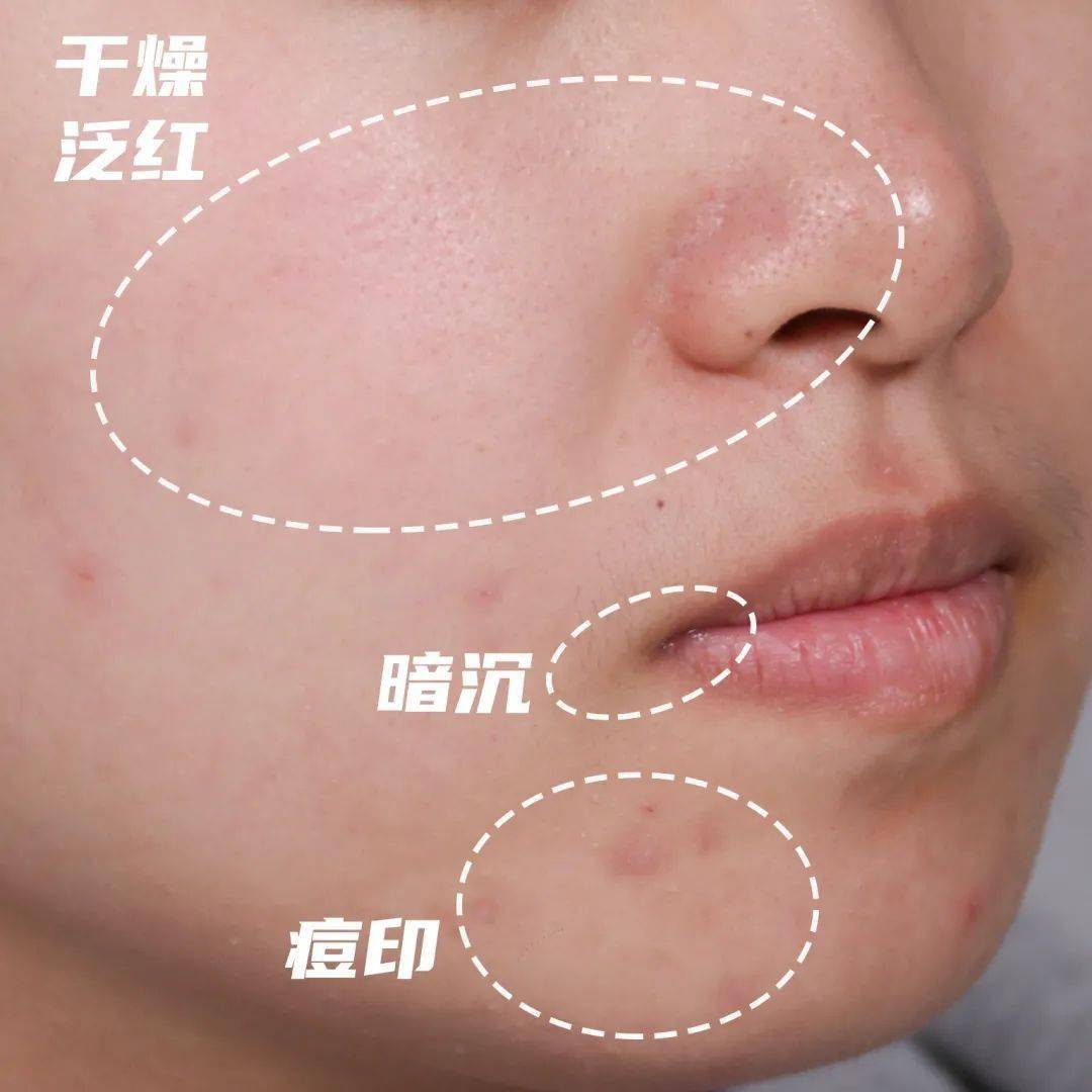 其实皮肤作为人体最大的器官,没错,皮肤是器官,工作压力也是直接导致