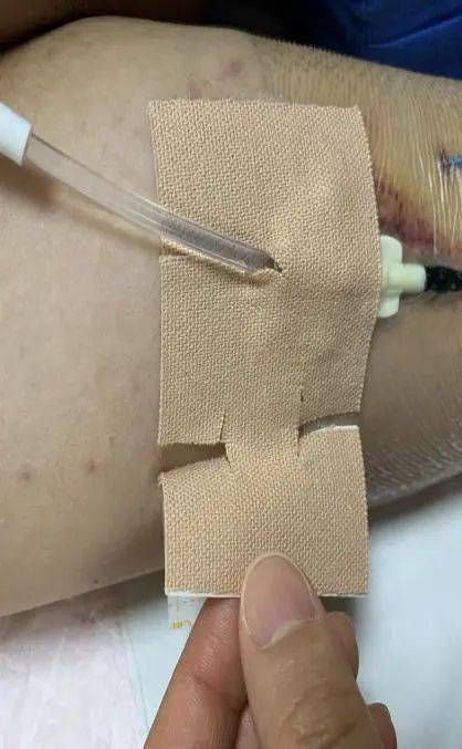 3种picc固定方式你get了吗?