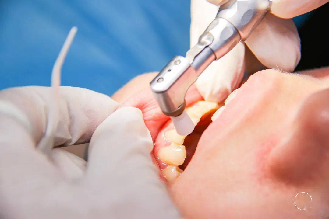 口腔全面检查 超声洁牙 无痕护釉抛光._牙齿