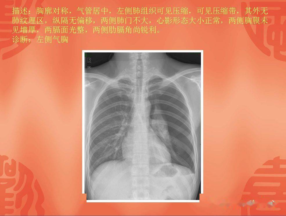 肺部气液平面图片