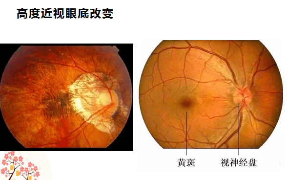 眼壁因被拉伸变薄,所以有一些弧形斑出现,并伴有脉络膜萎缩