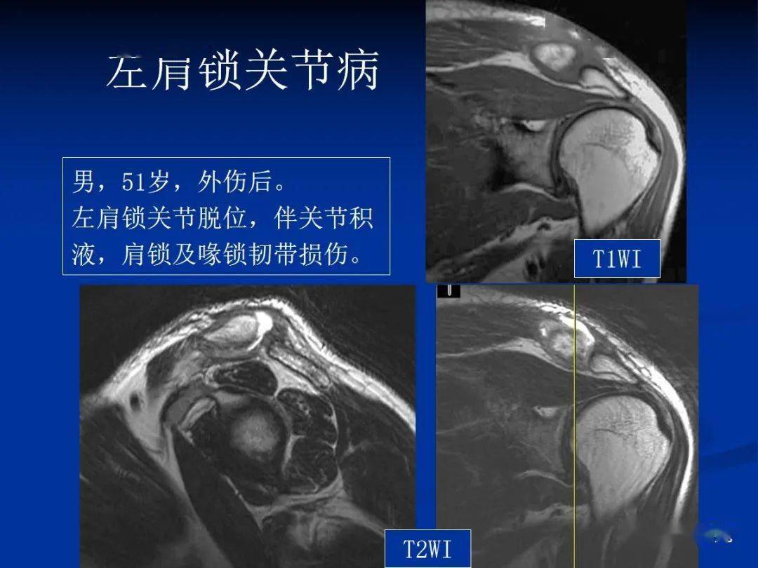 肩袖解剖及损伤的临床及mri诊断