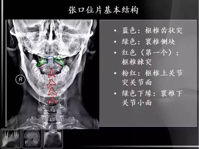 详细颈椎x线解读及关于颈椎病的影像学诊断及分型汇总