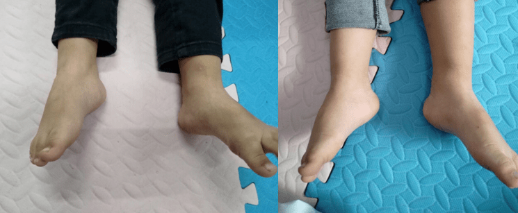 第二次绷带矫正后点击边框调出视频工具条痉挛型偏瘫功能性长短腿sbc