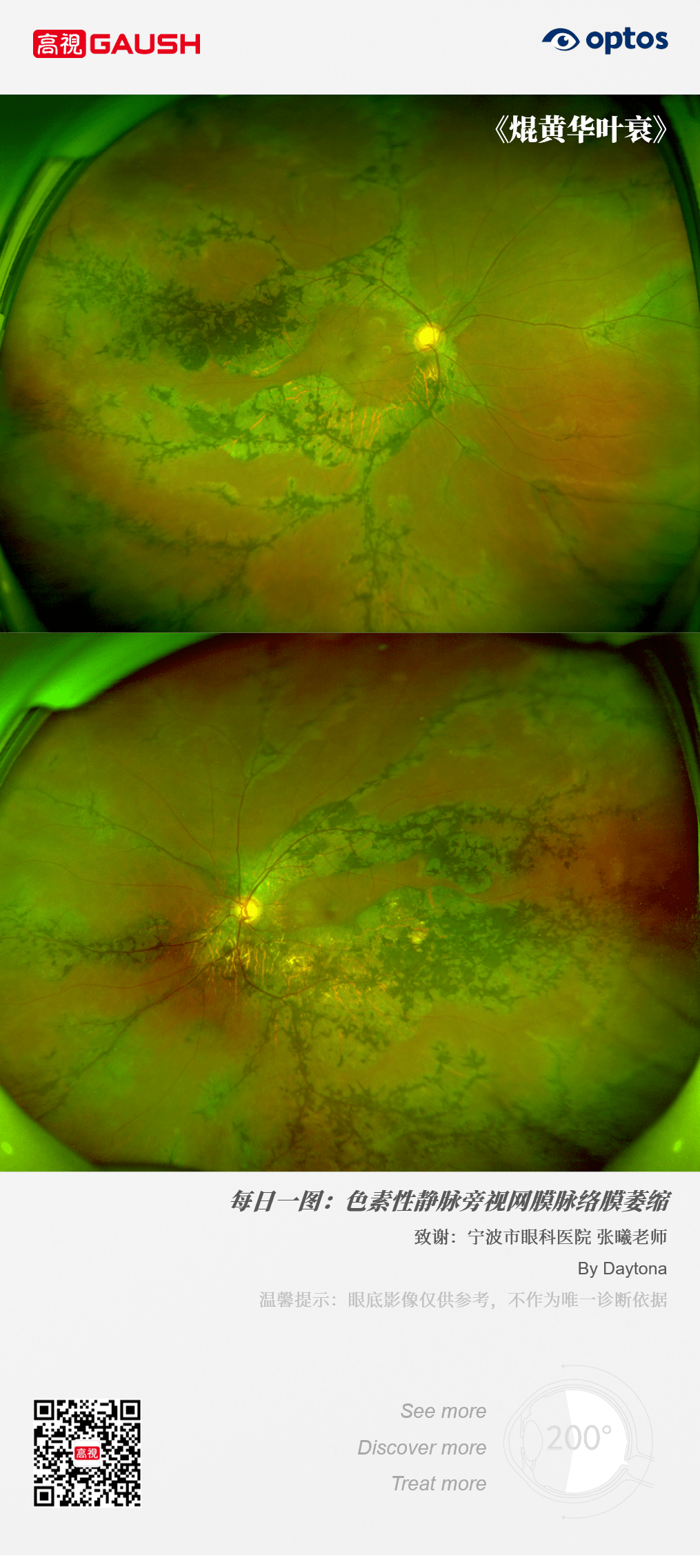 每日一图|色素性静脉旁视网膜脉络膜萎缩