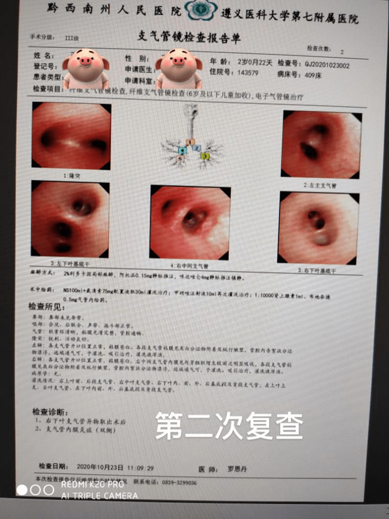 不让坚果粒要了您孩子的命 州人民医院已成熟开展多例支气管镜介入