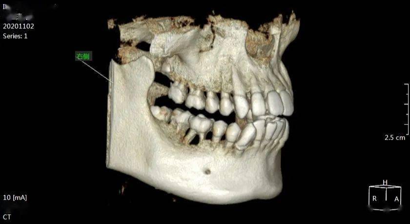 双根 未压迫同侧神经管 46牙冠隐裂至根分叉底 牙槽骨吸收至根中1/3