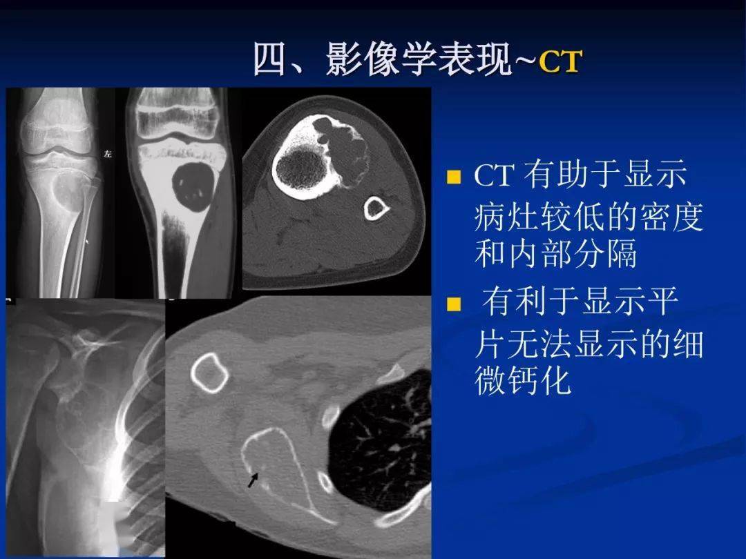 软骨粘液样纤维瘤影像学诊断