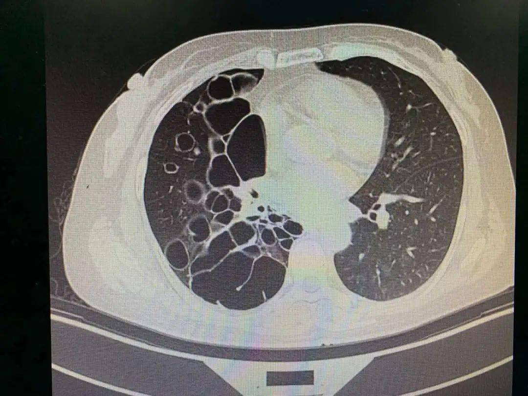 胸部ct示:气管通畅,右主支气管后方见囊状透亮影;右肺支气管呈囊柱状