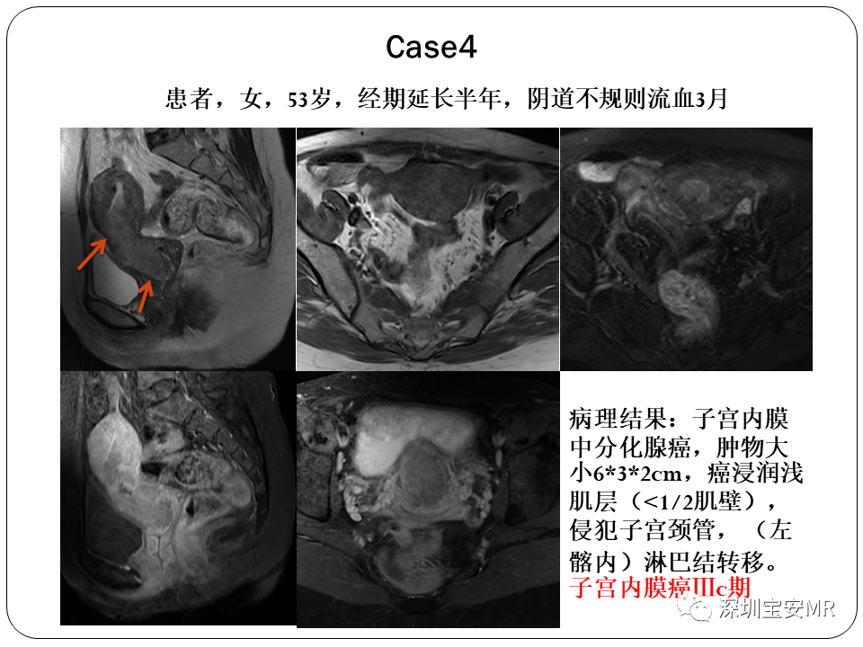 子宫内膜癌MRI诊断及鉴别诊断