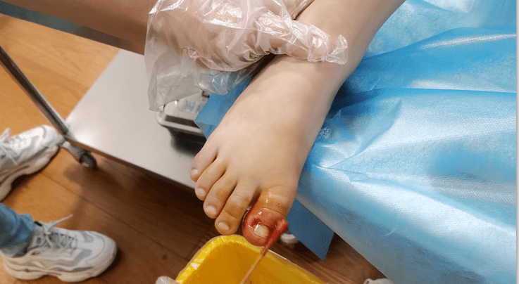 工友于16:15陪同下来到家有健康萝岗门诊就诊,医生在局麻下予清创缝合