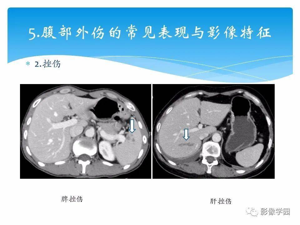 常见腹部外伤的影像诊断