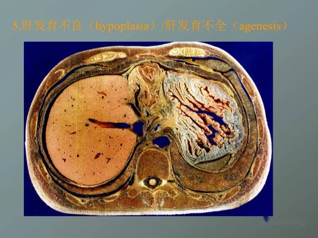 少许肝组织和迷走肝管,若其内仍有完整肝组织,形成的肝叶就是"獭尾肝"
