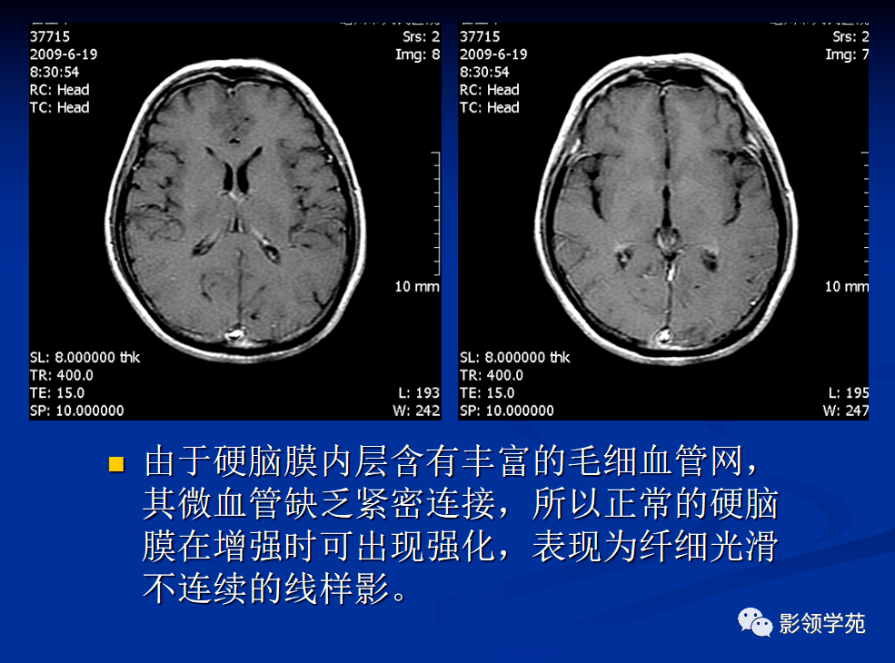 部軟腦膜蛛網膜型轉移脊柱nhl廣泛蛛網膜-軟腦膜型轉移肺癌硬腦膜型轉