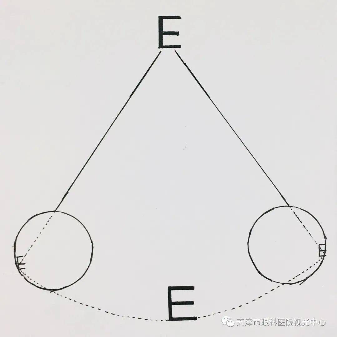 双眼视异常在生活中有这几种表现,看看你中招了吗?