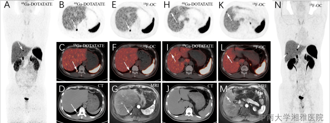 诺华net之声丨18f奥曲肽pet显像知多少
