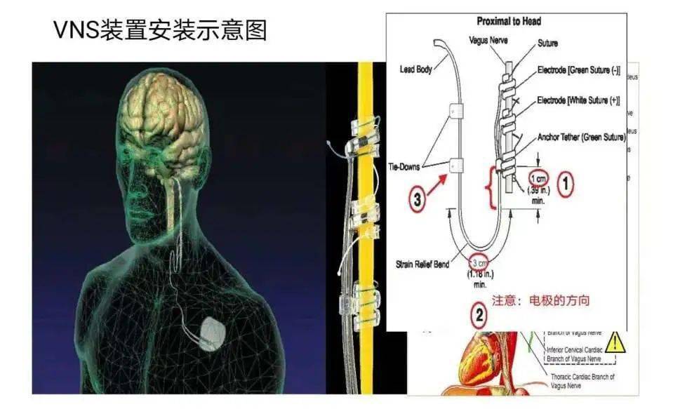 脑电图电极安装位置图片