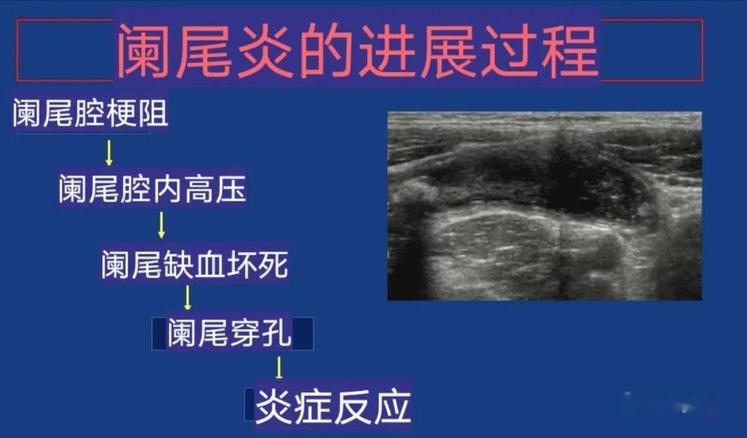 谈谈超声诊断阑尾炎