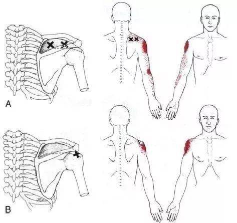 肩膀痛点结构图片图片