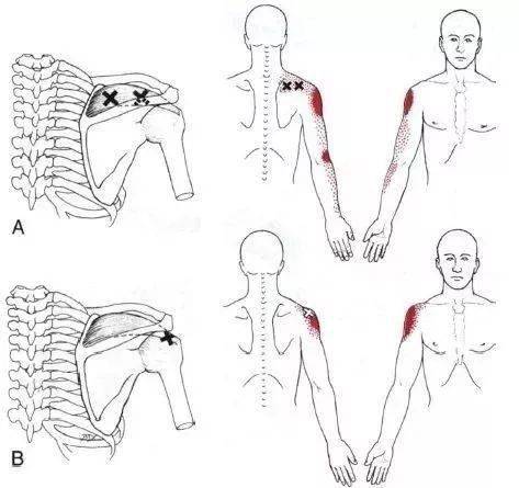 肩背肌筋膜炎痛点图片图片