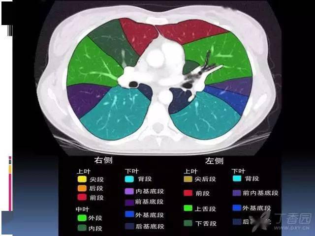 ct入门肺叶分段支气管肺动脉ct图谱全在这