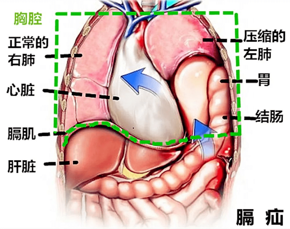 湘潭滴罗娭毑剧烈呕吐67ct一看胃都进胸腔了