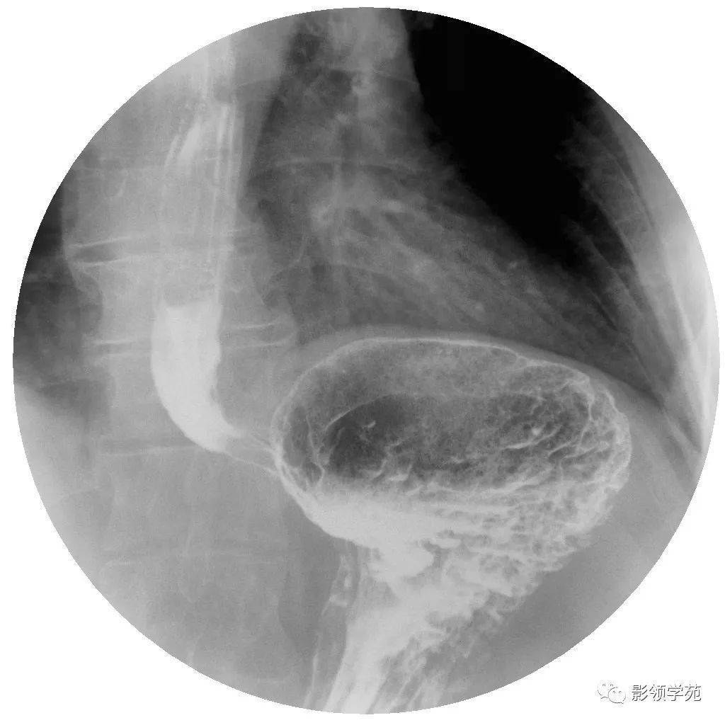 食管裂孔疝A环图片