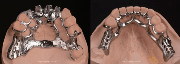 设计45放置颊侧i杆,远中邻面板,因舌系带过高,采用变异"人"形双舌杆.