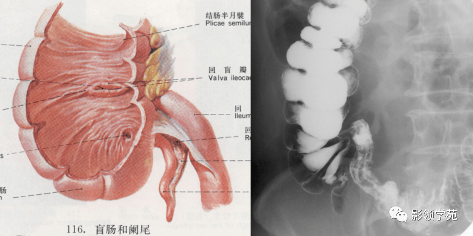 回盲部位于右下腹髂窝处,是以回盲瓣为中心 ,包括盲肠,阑尾,回肠末端