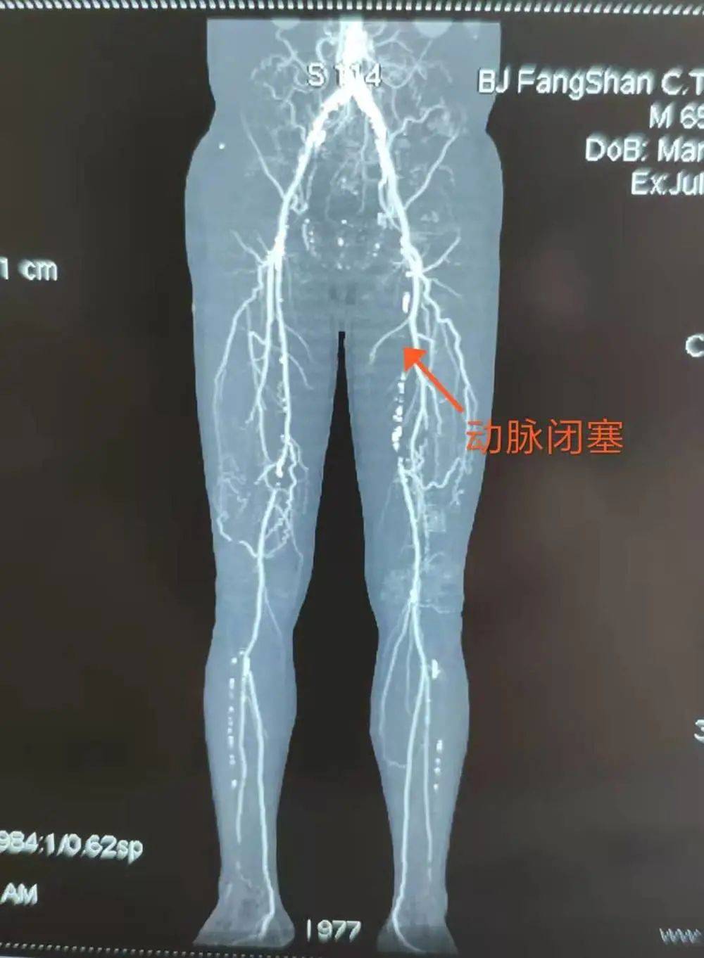健康科普血管发出的警告您重视了吗
