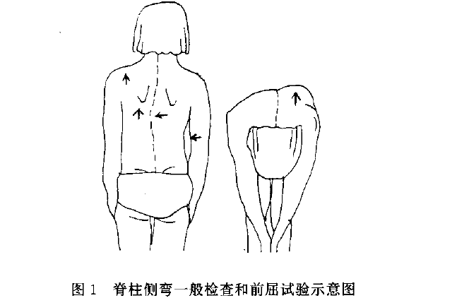 除外观观察,还可以做前屈实验,脚跟并拢,双腿伸直,躯干前屈90度,双手