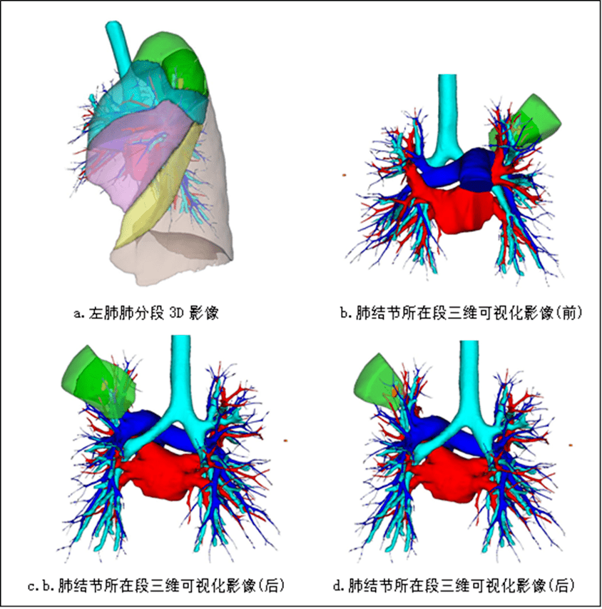 较常规的肺叶手术更为精细,肺段手术需要辨识3-4级支气管及相应的血管