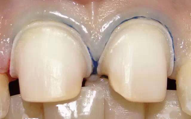 备牙后没抛光会发生什么你知道吗