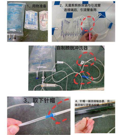 3 步轻松解除尿管堵塞