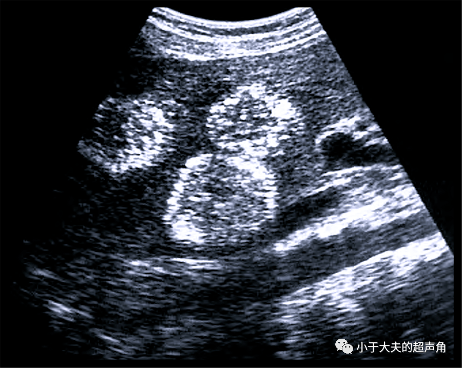 超声随响第28期肝紫癜症peliosishepatis