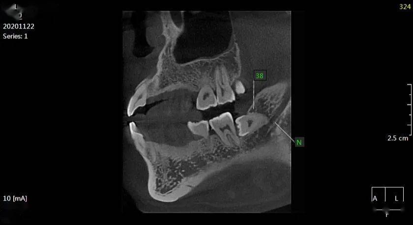 ct示:38水平阻生,融合根,根尖紧邻下颌神经管上壁,16缺失,近远中冠