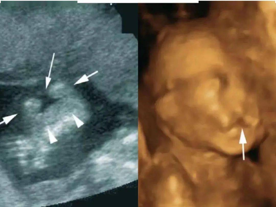 知多点 | 胎儿唇腭裂,你需要了解更多