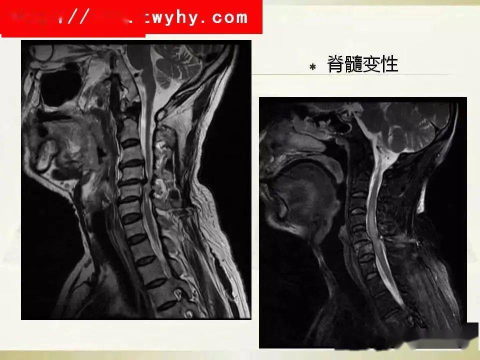 颈椎病的土方法最佳治疗_治疗颈椎病的土方法有哪些_治疗颈椎的最好土方法视频教程