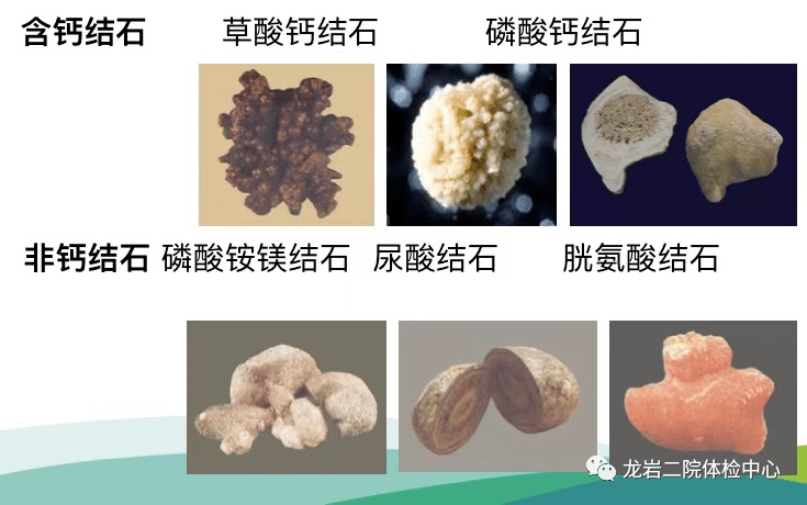 根据结石成分及特性来区分,以草酸钙结石最常见,磷酸盐,尿酸盐,碳酸盐