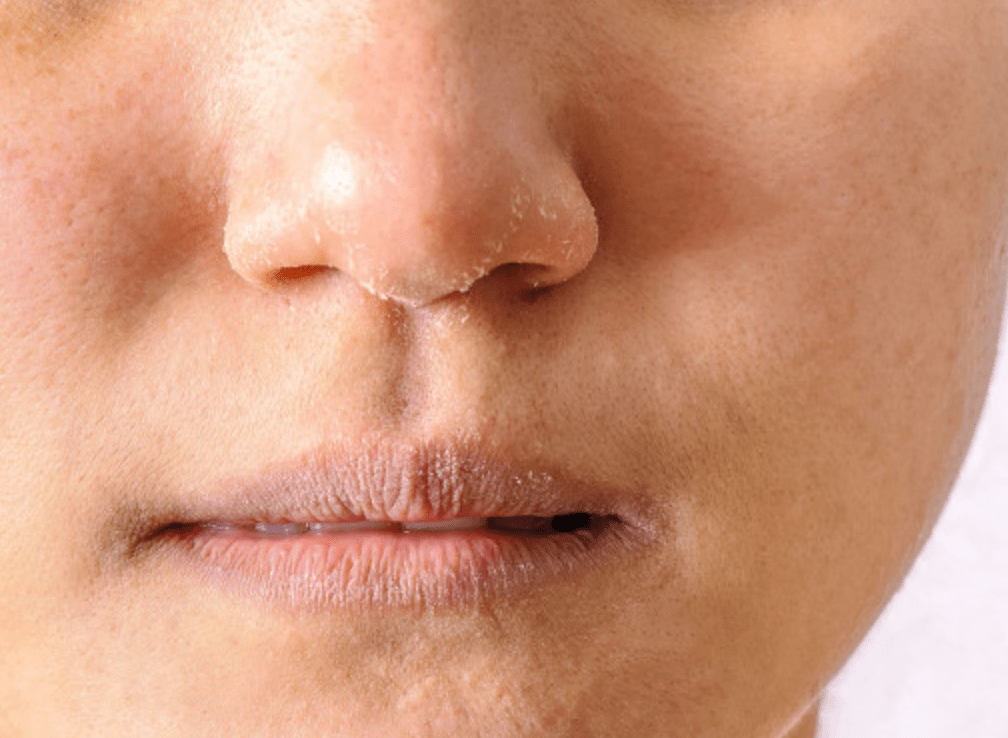 1,干到炸裂:抹精华上脸就蒸发,嘴唇干到裂口子,喘个气鼻孔都干到不行.