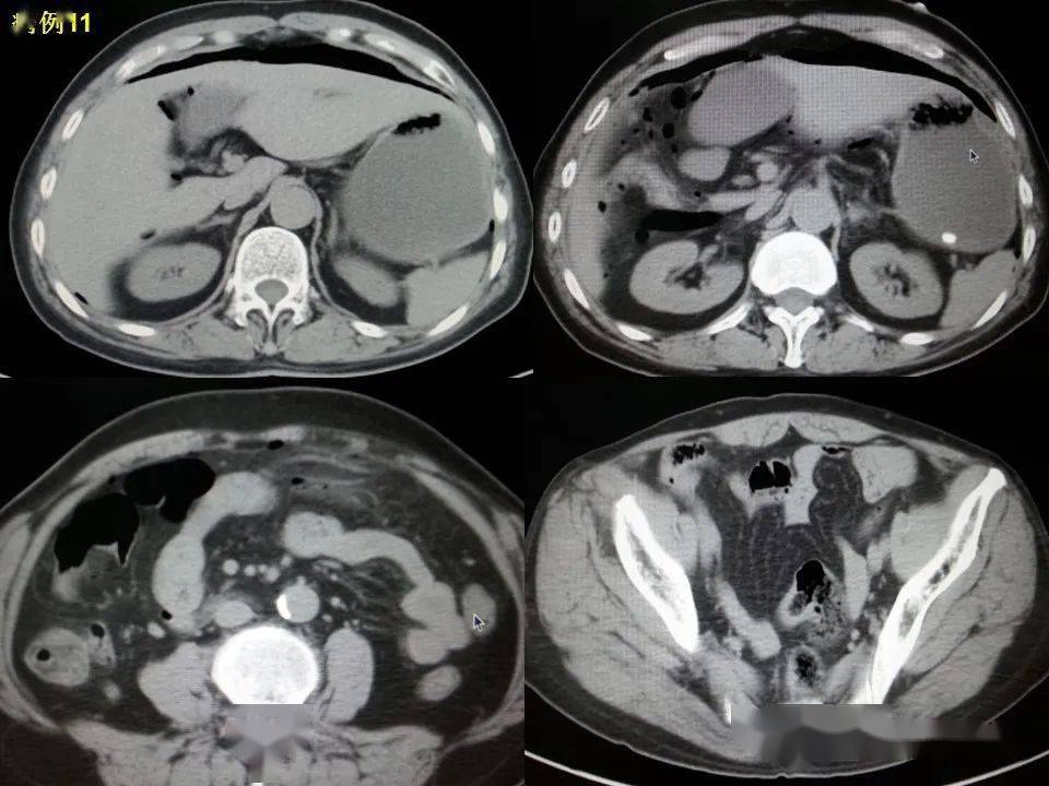 消化道穿孔CT图片