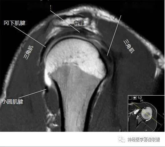 肩关节韧带mri解剖图图片