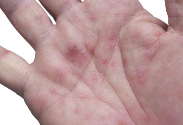 手掌有这种颜色或是肝掌及时检查肝