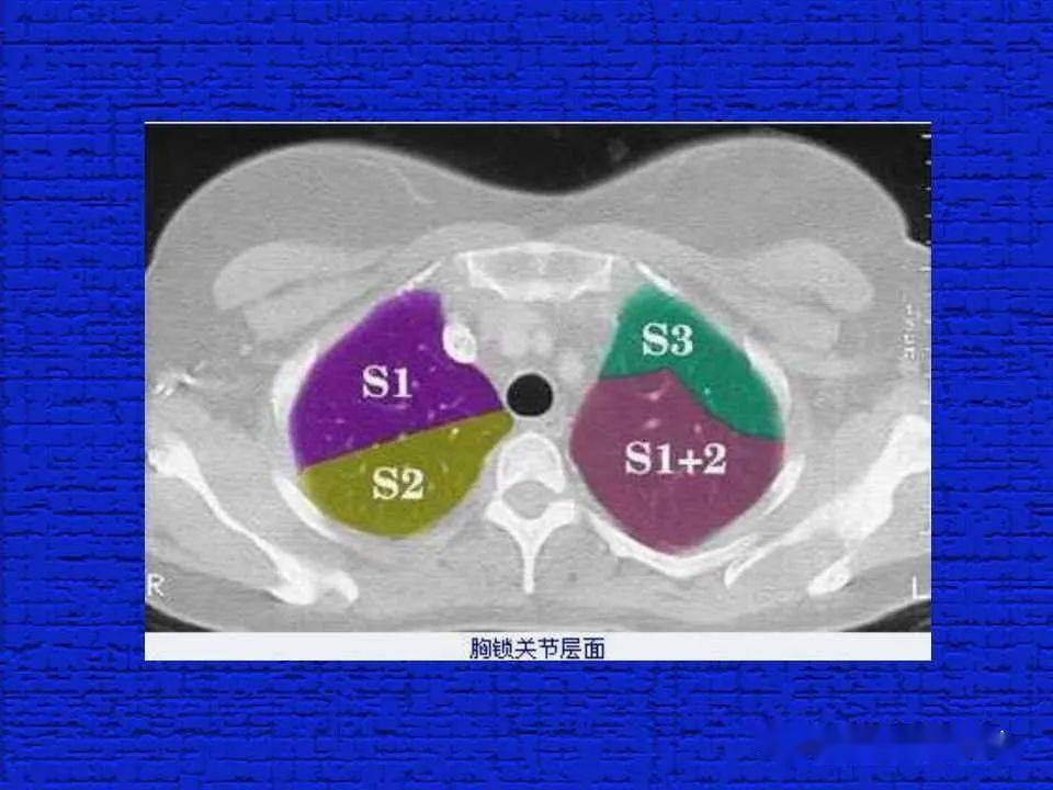 结合解剖谈正常胸部CT读片-搜狐大视野-搜狐新闻